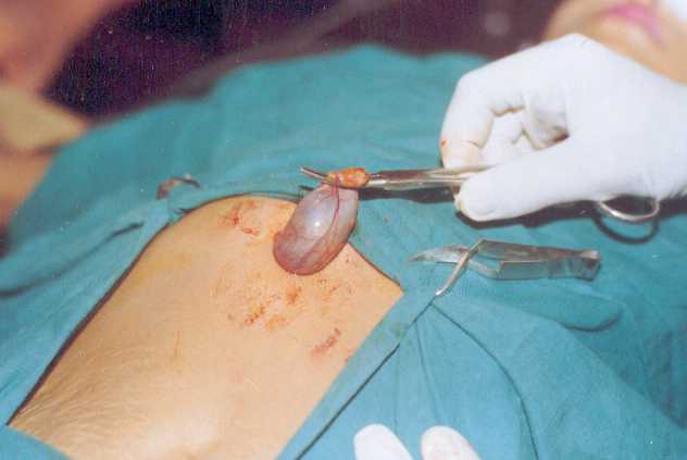 Gall Bladder Removal From Small Incision
